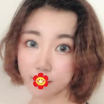 绍兴做鼻子哪个医院好,我选择绍兴维美康乐做了假体+耳软骨综合隆鼻,成功摆脱“扁塌鼻” 图2