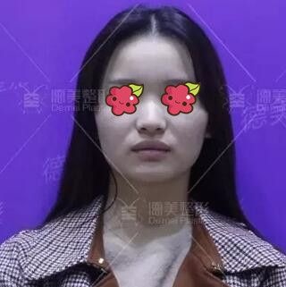 邵阳德美是正规医院么?用我找李倩做的肋软骨复合隆鼻术后3个月恢复效果图告诉你!