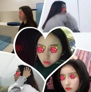 邵阳德美是正规医院么?用我找李倩做的肋软骨复合隆鼻术后3个月恢复效果图告诉你! 图2