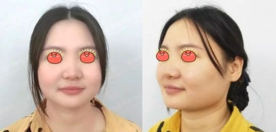 嘉兴禾美隆鼻案例术后一周效果纪实,一起见证我的新鼻子诞生过程吧