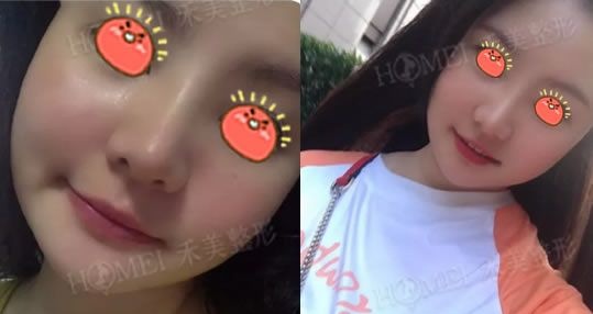 嘉兴禾美隆鼻案例术后一周效果纪实,一起见证我的新鼻子诞生过程吧 图2