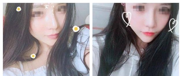 看过闺蜜在苏州紫馨做的鼻子自然不假,我也面诊医生做了韩式假体威宁二段综合鼻整形 图2