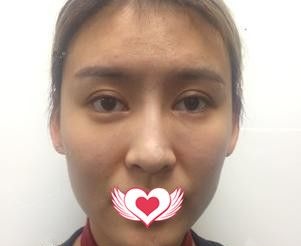 相比注射玻尿酸除皱 我选择在石家庄天宏做了维持时间较长久的埋线提升手术 术后肤质紧致亮白还能塑造V字脸