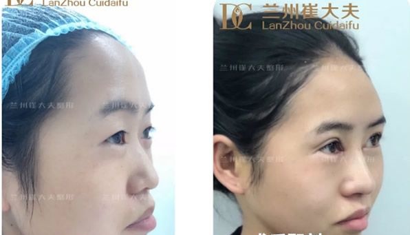 兰州崔大夫割双眼皮技术怎么样 全切双眼皮和鼻综合隆鼻第10天效果值得一看