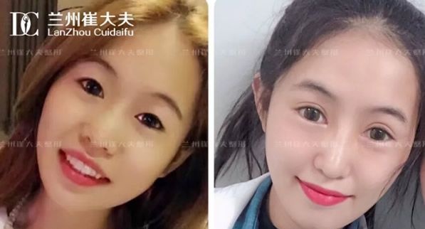 兰州崔大夫割双眼皮技术怎么样 全切双眼皮和鼻综合隆鼻第10天效果值得一看 图2
