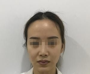 对自己唇形不满意选择石家庄天宏注射瑞蓝2号玻尿酸1ml打造打造微笑嘟嘟唇 术后20天恢复自然且没有肿胀感