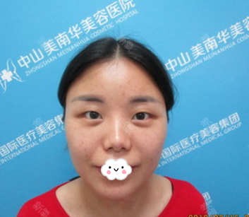 面诊感觉中山美南华整形医院挺正规的就找王斌院长做了全切双眼皮