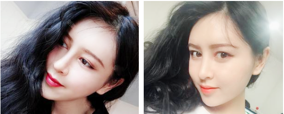 东莞脂肪填充哪家好？参考我找东莞壹加壹王擎院长做的全脸脂肪填充恢复期照片吧 案例图2