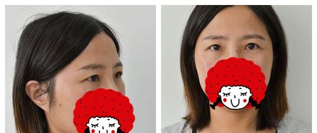 原本内双眼因皮肤松弛变单眼皮 找苏州紫馨孙影做了割双眼皮+去皮眼综合后get到妈生原装8mm双眼皮效果