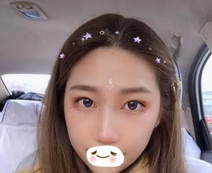 来说说我在张家口天宏找王慧东做切开双眼皮+开眼角手术后从眯眯小眼到灵动媚眼的经历 案例图2