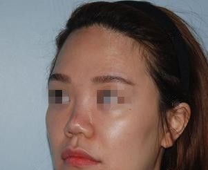 塌塌鼻+凹陷脸让我土气又显老 经过张家口天宏做鼻综合整形+面部自体脂肪填充后蜕变气质女神