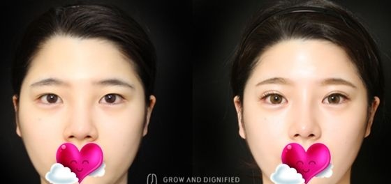 上几张在长春姬安娣整形做全脸自体脂肪填充,外加鼻综合和切开双眼皮大改造后的效果图