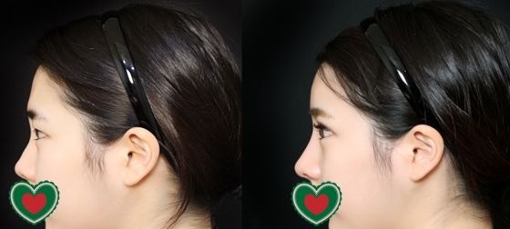 上几张在长春姬安娣整形做全脸自体脂肪填充,外加鼻综合和切开双眼皮大改造后的效果图 图2