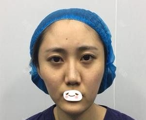 在石家庄天宏采用自体脂肪填充额头、苹果肌、太阳穴、下巴后 使原本凹陷脸的我竟拥有了人见人羡的混血脸