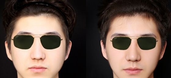 长春姬安娣整形金洪达院长面部轮廓案例:硅胶假体垫下巴和驼峰鼻矫正