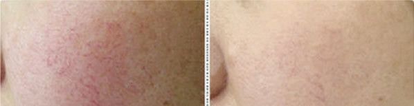 兰州哪家医院能做脉冲染料激光去红血丝?价格多少钱?看兰州时光贾治兰染料激光595案例