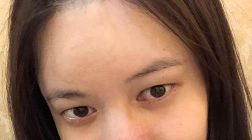 温州艺兴整形医院做了双眼皮和开眼角+做鼻子,效果都挺不错的