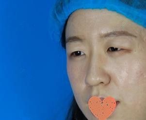 前段时间我在郑州华领做全切双眼皮+开内眼角手术 现在恢复28天就由三角眯眯眼瞬变妩媚大电眼