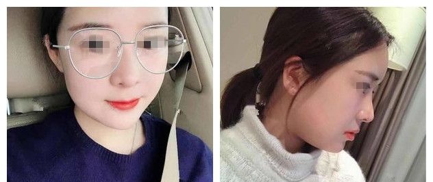 初次做的假体隆鼻术后鼻头歪到苏州紫馨口碑医院做了鼻综合修复,顺带还抽吸大腿脂肪填充到面部改善凹陷 图2