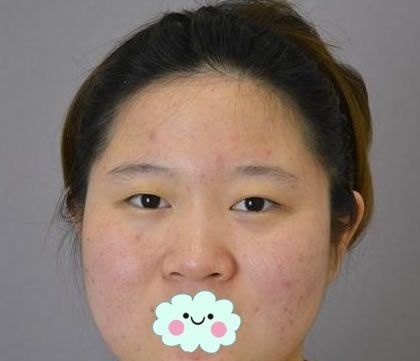 从事前台工作的妹子来温州爱尚玉熙强做了肋软骨鼻综合隆鼻手术