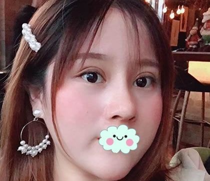 从事前台工作的妹子来温州爱尚玉熙强做了肋软骨鼻综合隆鼻手术 图2