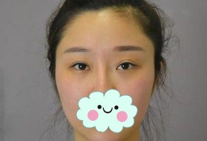 我虽然是天生双眼皮,但双眼皮不对称,考虑后选择温州爱尚玉熙郑静伟做了双眼皮和开眼角