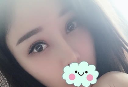 我虽然是天生双眼皮,但双眼皮不对称,考虑后选择温州爱尚玉熙郑静伟做了双眼皮和开眼角 图2