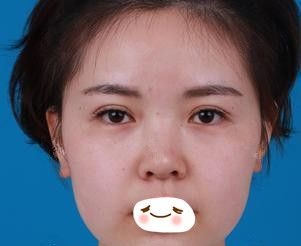 天生婴儿肥面部臃肿的我选择石家庄天宏做面部吸脂手术1个月后呈现精致立体小V脸