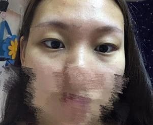 随着年龄增长眼袋深超显老 在石家庄天宏面诊张学雷医生建议我做内切去眼袋手术 恢复25天后效果好还毫无痕迹