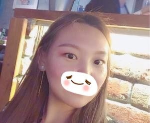 随着年龄增长眼袋深超显老 在石家庄天宏面诊张学雷医生建议我做内切去眼袋手术 恢复25天后效果好还毫无痕迹 图2