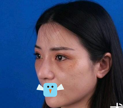 内江达芬奇陈科激光去眼袋治疗速度好快,半个多小时就结束了,完全不影响我正常工作