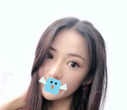 内江达芬奇陈科激光去眼袋治疗速度好快,半个多小时就结束了,完全不影响我正常工作 图2