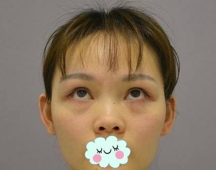 拜拜,眼袋君,我在温州爱尚玉熙整形做内切去眼袋全记录,没眼袋后真是太美好了