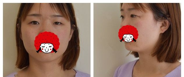 5组照片告诉你为什么我到苏州紫馨做了双眼皮+开眼角眼综合之后又去做了激光美肤+瘦脸