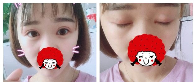 5组照片告诉你为什么我到苏州紫馨做了双眼皮+开眼角眼综合之后又去做了激光美肤+瘦脸 图2