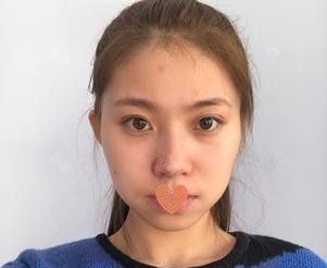  肉肉大饼脸的我一直想拥有精致小V脸 来到张家口天宏找王慧东医生注射一支瘦脸就能轻松搞定