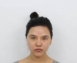 郑州自体脂肪填充多少钱?花12800元找华领做了全脸填充后,发小居然认不出来我了
