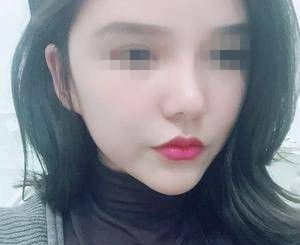 郑州自体脂肪填充多少钱?花12800元找华领做了全脸填充后,发小居然认不出来我了 图2