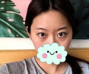 台州也有yestar艺星整形了,这是我刚在台州艺兴做完双眼皮和开眼角后眼睛效果,看看好不好看