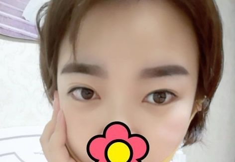 真人案例:呼和浩特五洲女子医院整形科王焕给大家说说韩式定位双眼皮和切开双眼皮区别