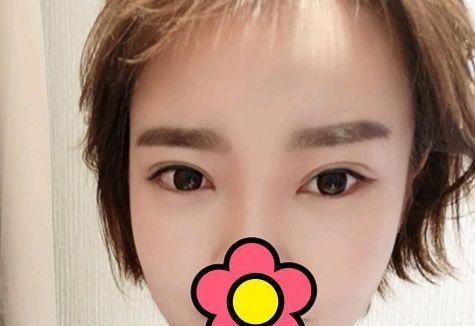 真人案例:呼和浩特五洲女子医院整形科王焕给大家说说韩式定位双眼皮和切开双眼皮区别 图2