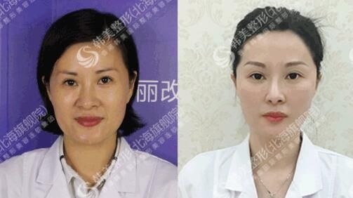 这是我在北海韩美整形做全脸线雕提升前后对比照片，亲们觉得我面部埋线的效果怎么样