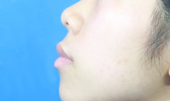 亲们!呼和浩特京美整形医院马晓艳假体垫下巴费用和垫完下巴恢复过程图是这样滴!