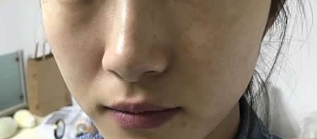 在宜春天泽整形医院找周玲主任做激光祛斑后仅仅20天脸上干净多了