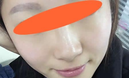 在宜春天泽整形医院找周玲主任做激光祛斑后仅仅20天脸上干净多了 案例图2