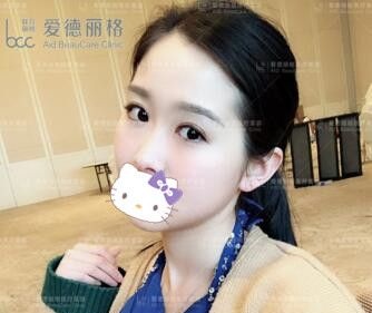找大连爱德丽格刘志刚做双眼皮修复术后30天恢复效果图分享 图2