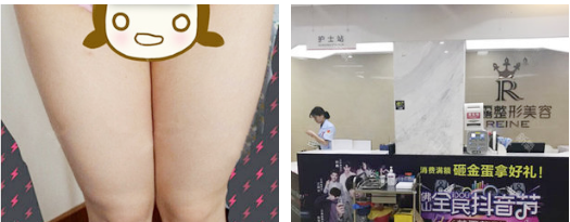 这次找佛山梦露整形游万福院长做的大腿吸脂效果太好了,后悔没有用抽出来的脂肪做隆胸