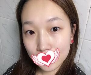 大连爱德丽格冯勇医生怎么样?看了冯勇做的双眼皮+开内眼角术后30天真人案例效果图就知道了