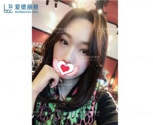 大连爱德丽格冯勇医生怎么样?看了冯勇做的双眼皮+开内眼角术后30天真人案例效果图就知道了 图2