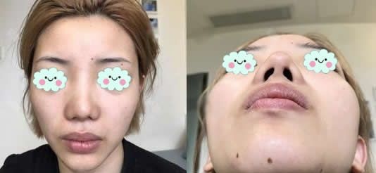 真实纪录,还原我在台州yestar艺星做隆鼻失败后成功修复的过程及恢复效果,感谢王波主任